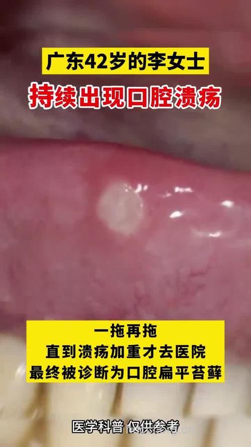 扁平苔藓会出现溃疡吗