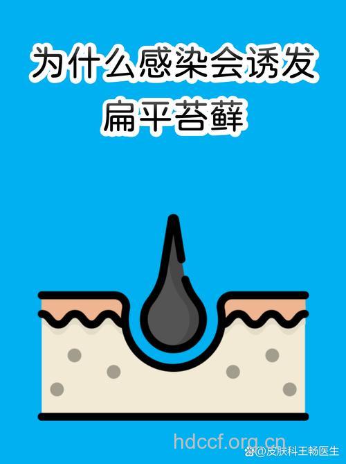 精神因素会引发扁平苔藓吗