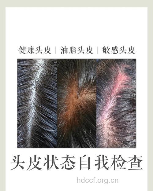 3个小测试自检头皮受伤没