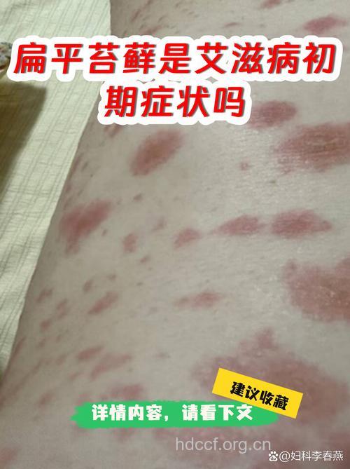 容易与扁平苔藓混淆的6种病