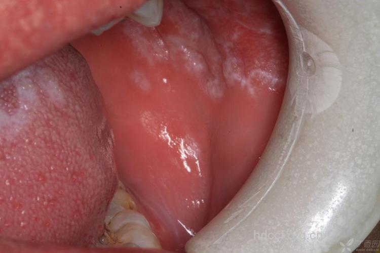 绿豆鸡蛋治疗口腔扁平苔藓