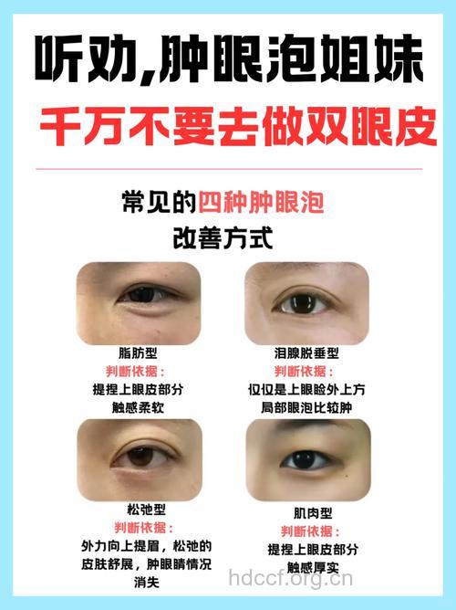 改善肿眼泡儿的四个小窍门