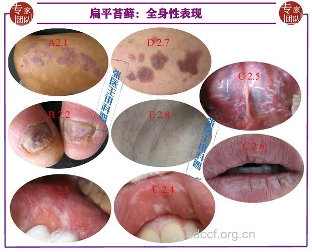 扁平苔藓的10种病态特征