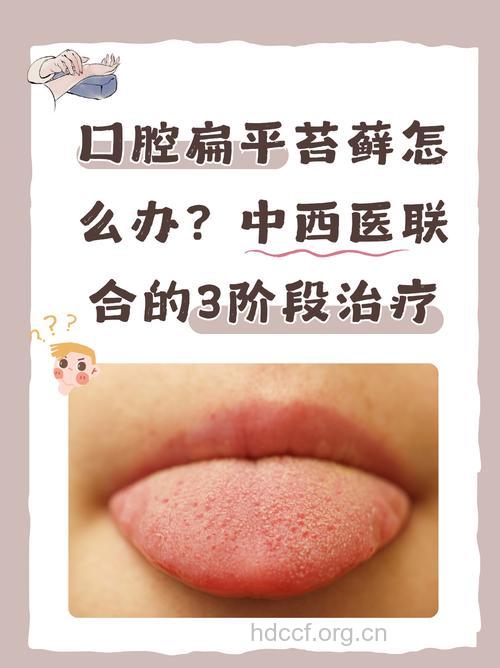 口腔扁平苔癣的中西医结合治疗疗法