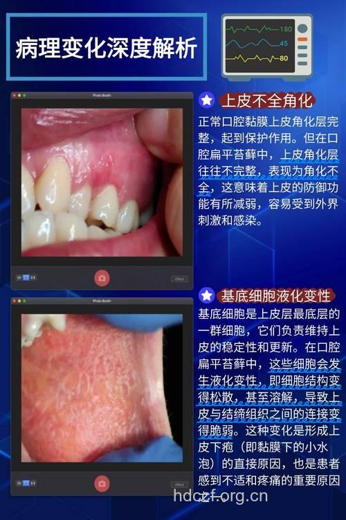 口腔扁平苔藓的病理病机