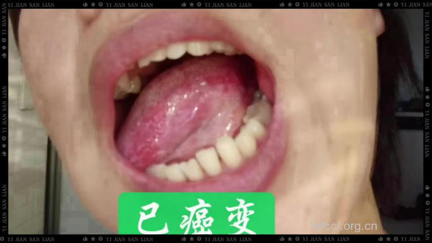 发现口腔里竟然“苔藓”!