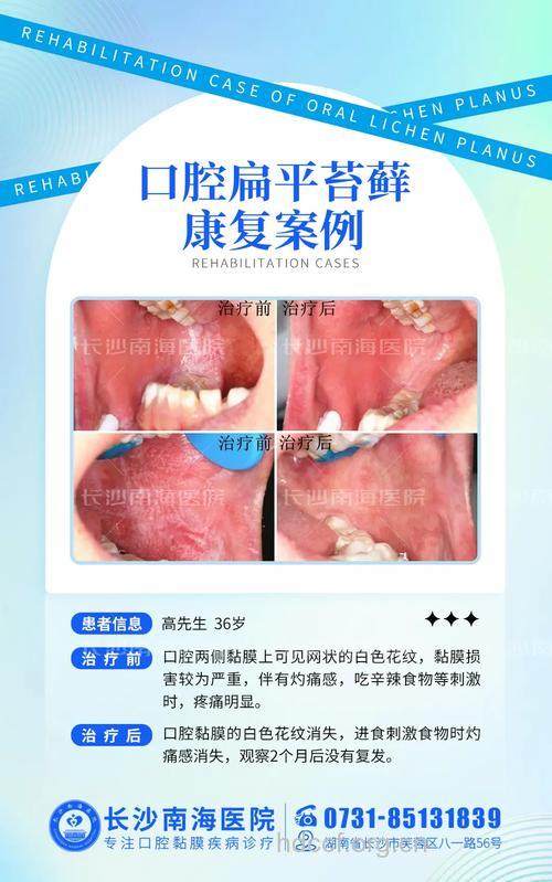 临床治疗口腔扁平苔藓疗效观察