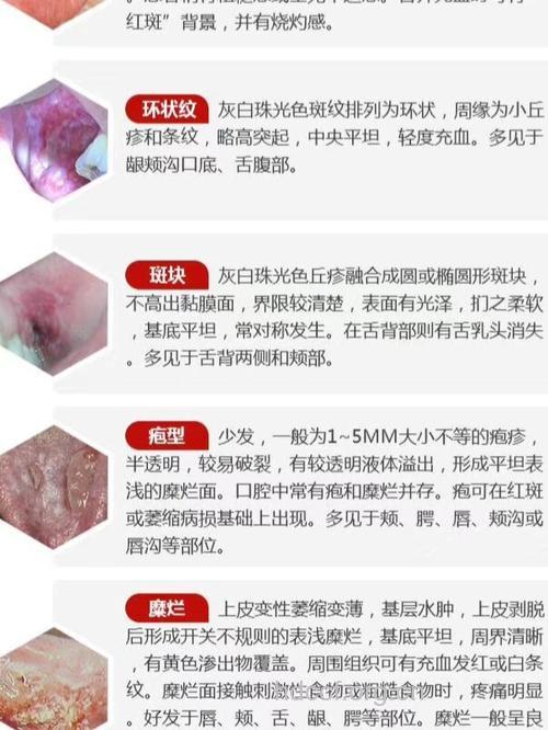 临床上口腔扁平苔藓分几类？