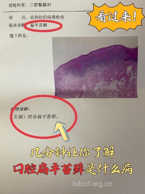 专家解读：扁平苔藓发病机理