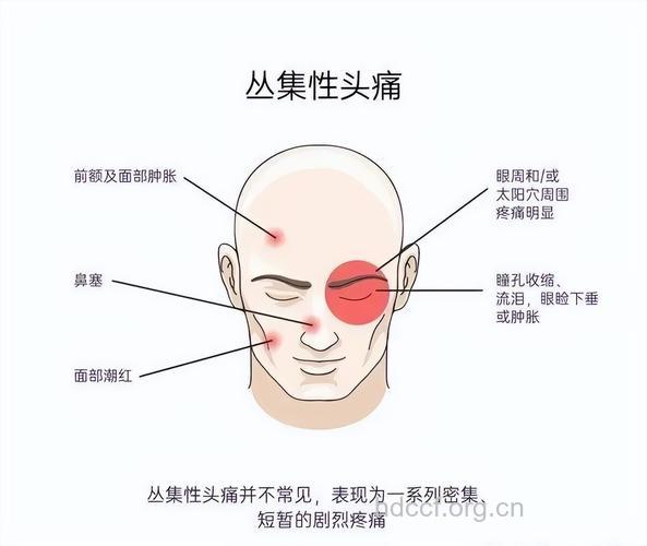 丛集性头痛的特点体现在哪里