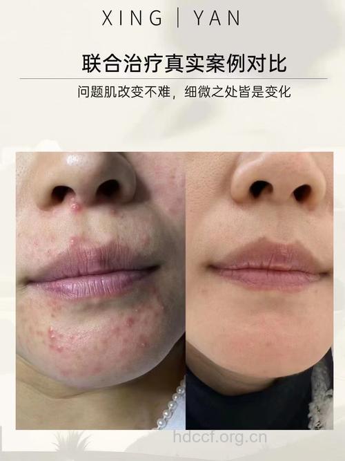 酸or碱？除痘战术对错比比看