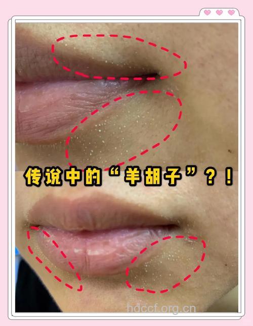 唇角小粉刺不挤也能轻松去除