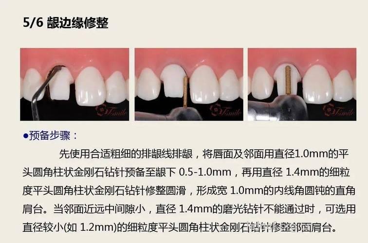 烤瓷牙前的准备工作有哪些