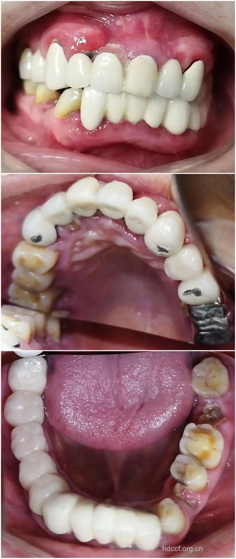 蛀牙可以做烤瓷牙吗