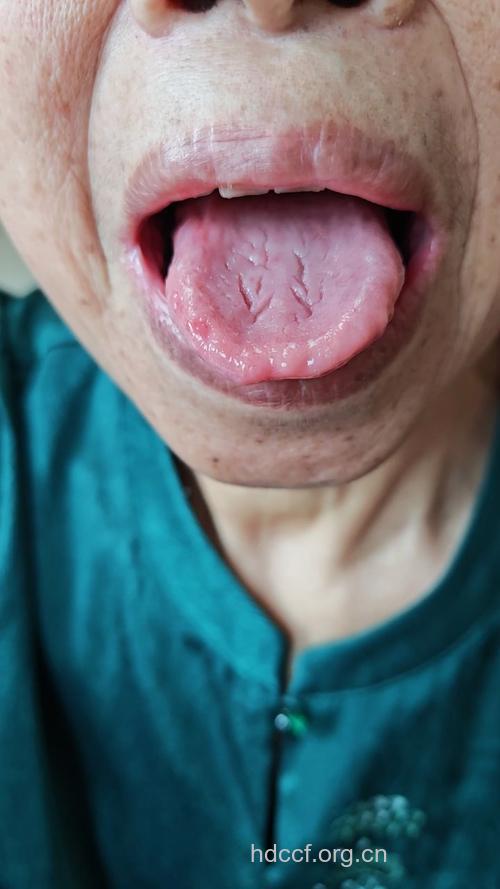 糖尿病患者易患口腔溃疡