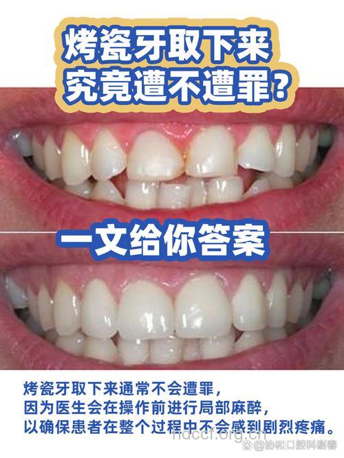 别让烤瓷牙伤害了你的牙龈