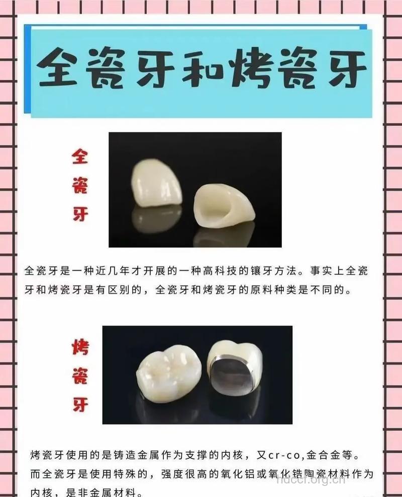 烤瓷牙与全瓷牙有什么区别