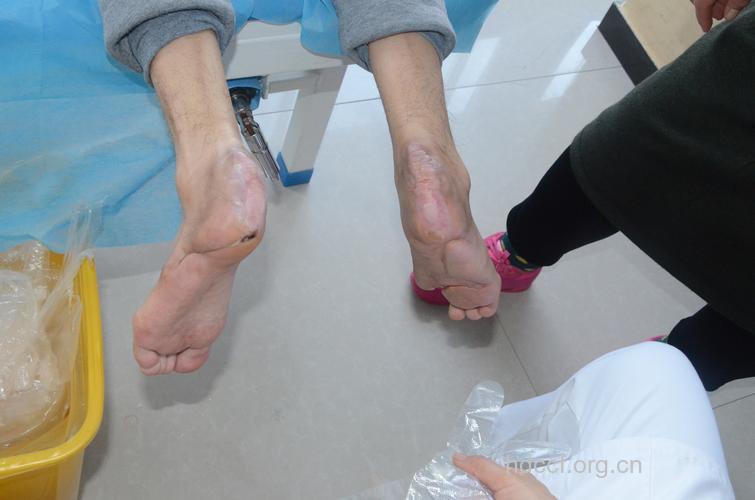 糖尿病肾病的康复案例