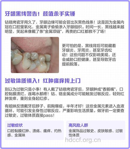 做烤瓷牙的风险和注意点