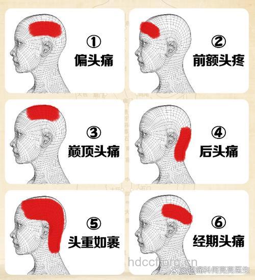 运动性偏头痛有哪些症状产生