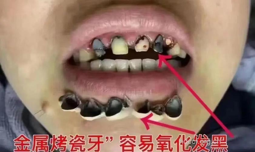 烤瓷牙內冠潜藏“杀手”