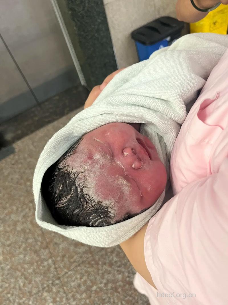 出生未满月就患上糖尿病的婴儿