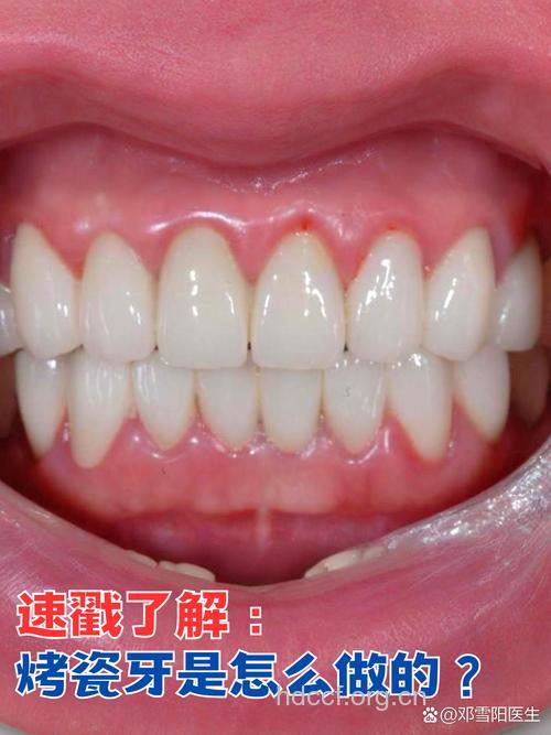 你知道玻璃烤瓷牙吗？