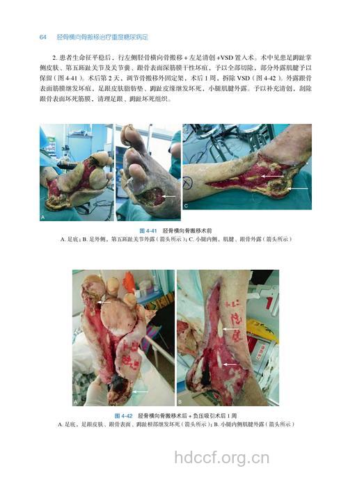 病例:手术给糖尿病患者带来希望