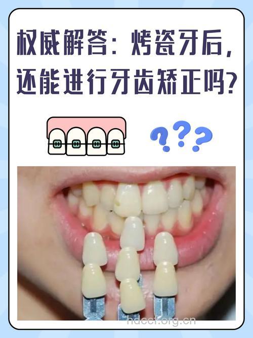 烤瓷牙的质量评价与自我维护