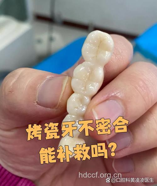 烤瓷牙不能随意镶