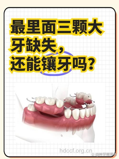 做烤瓷牙得“对号入座”