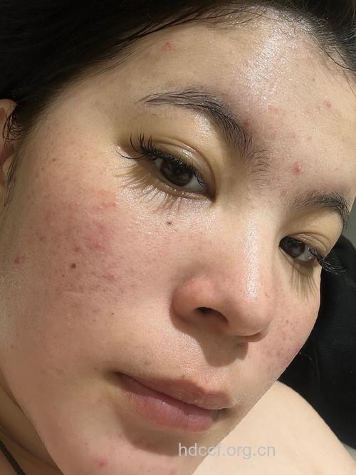 祛痘无痕 油皮妹美丽夏天