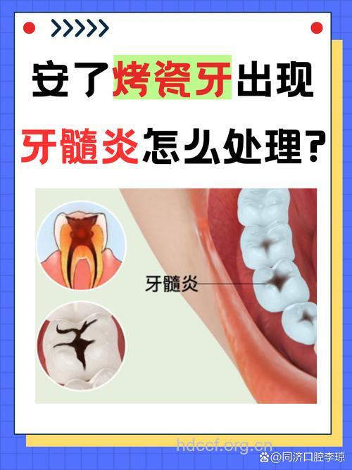 烤瓷牙会诱发什么病