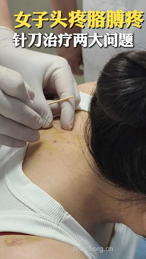 小针刀驱走2年偏头痛折磨