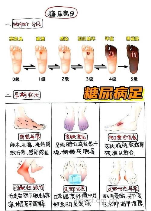 糖尿病脚趾麻木的危害有哪些