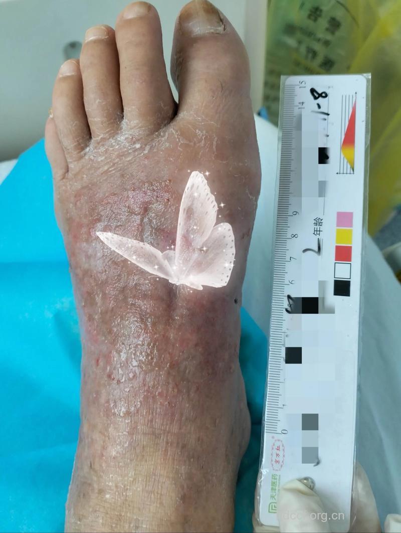 糖尿病患者 为什么伤口愈合的慢