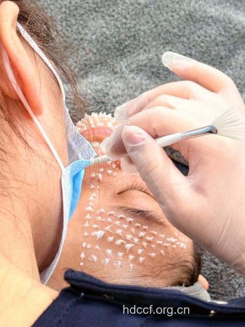 面部吸盘法 深度清洁给力