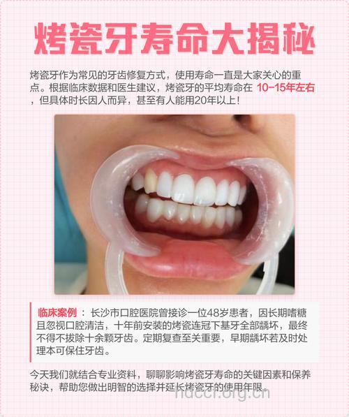 制作烤瓷冠需要多长时间