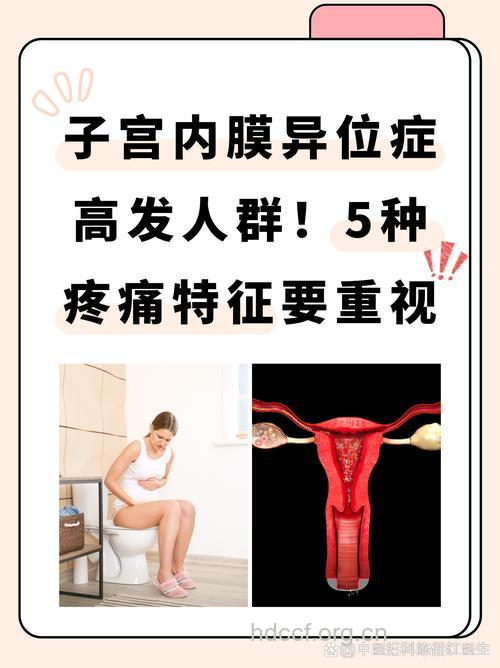 子宫内膜异位症与头痛