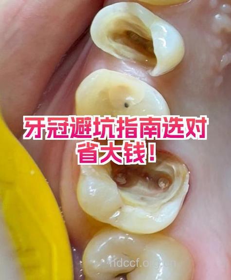 烤瓷牙的诱导与陷阱