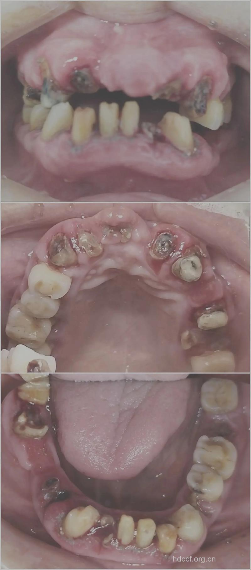 不适合做烤瓷牙的情况