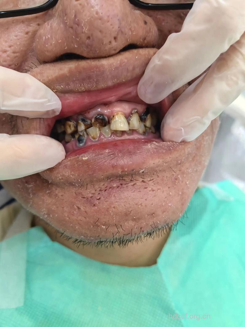 牙周炎患者的烤瓷牙镶复问题