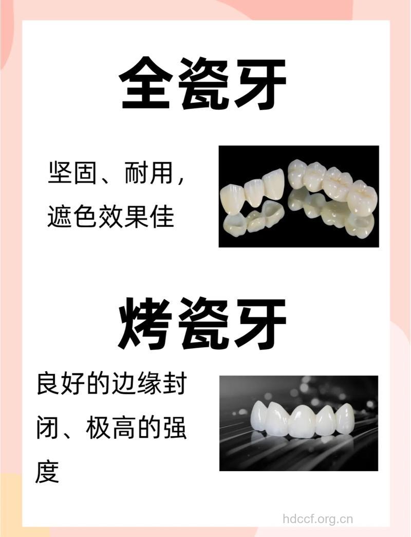 配戴烤瓷牙,你做好准备了吗