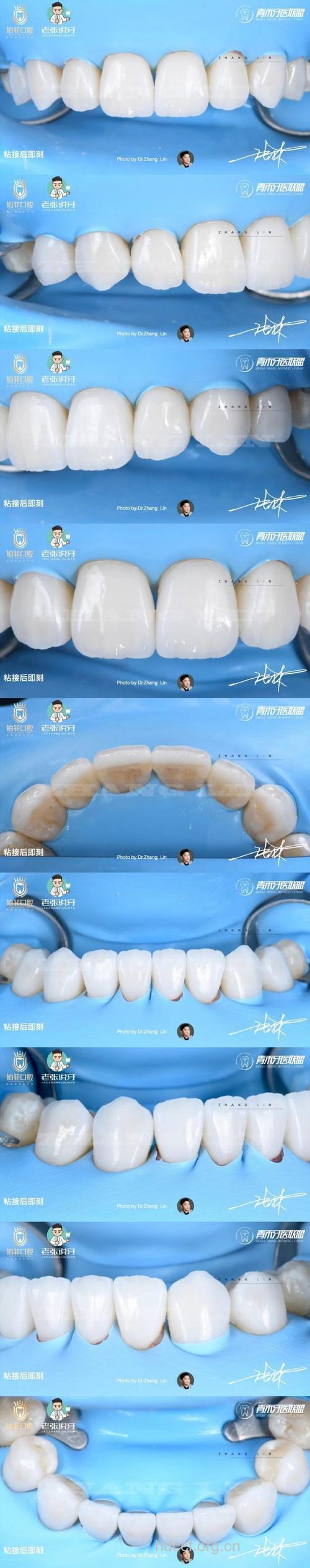新型牙齿－玻璃烤瓷牙