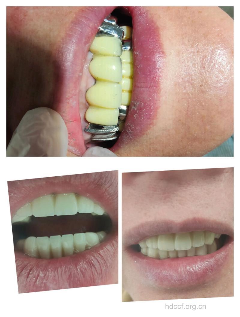 什么样的牙齿适合作烤瓷？