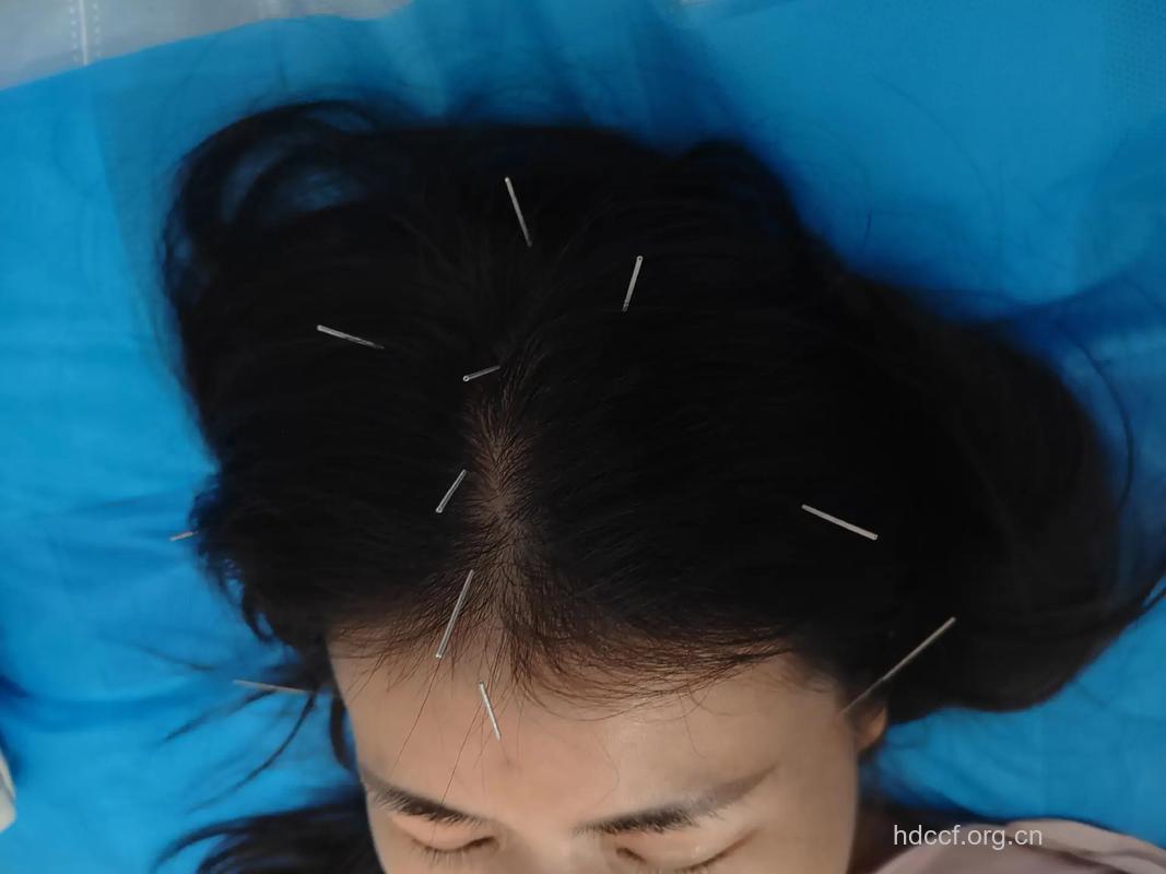 火罐配合针灸治疗头痛一绝