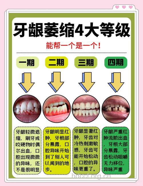 牙龈萎缩预防工作很重要