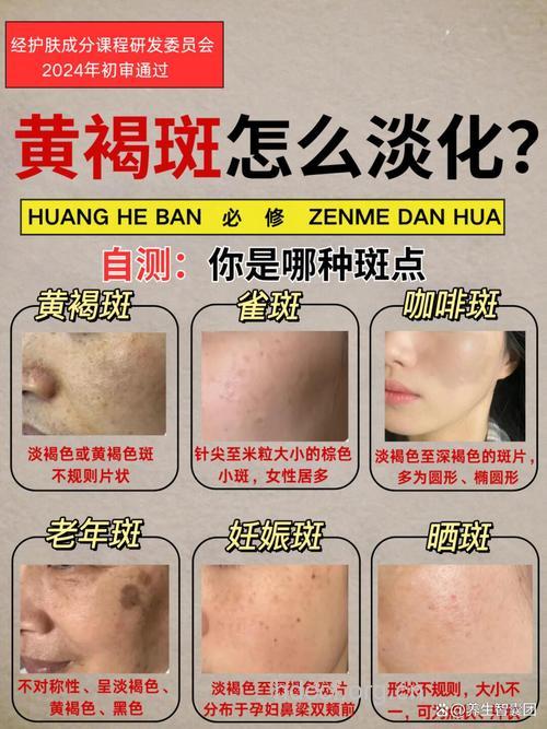 有哪些祛除蝴蝶斑方法