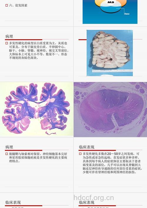 多发性硬化症的病理变化概述