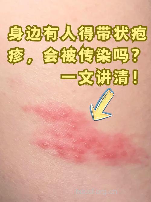 带状疱疹传染吗?